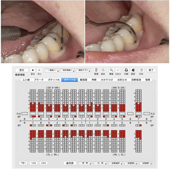 歯周ポケット検査