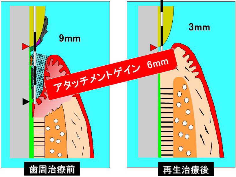 アタッチメントレベル　左：歯周治療前（9mm）　右：再生治療後（3mm）　アタッチメントゲイン　6mm