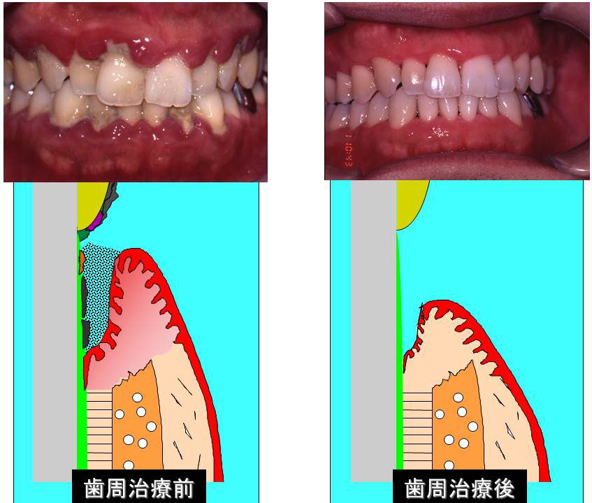 左：歯周治療前　右：歯周治療後