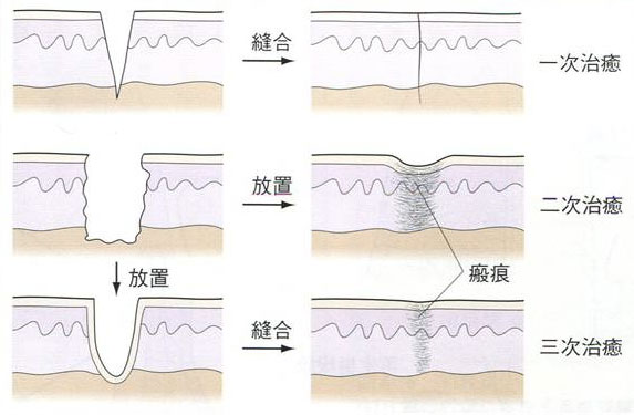 上から一次治癒、二次治癒、三次治癒の図