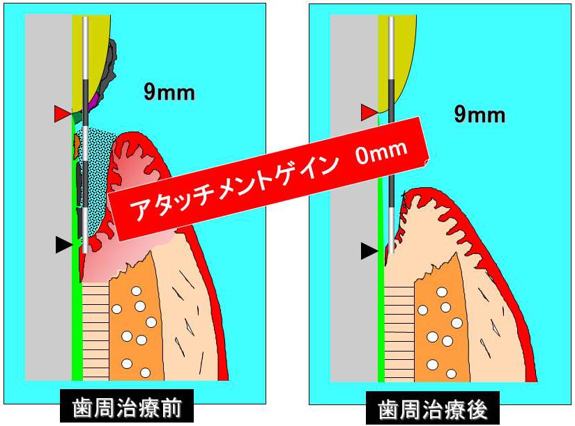 アタッチメントレベル　左：歯周治療前（9mm）　右：歯周治療後（9mm）　アタッチメントゲイン　0mm