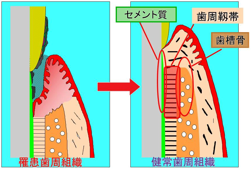 罹患歯周組織（左）→健常歯周組織（右）