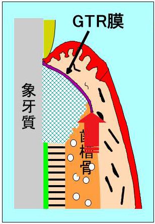 GTR組織再生誘導法