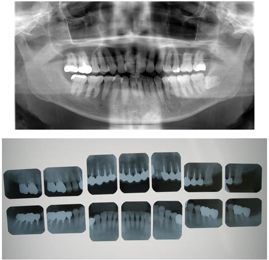 歯周疾患の診査 口腔内写真とX線写真 - はる歯科診療室 歯科業界