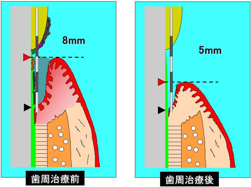 ポケットデプス　左：歯周治療前（8mm）　右：歯周治療後（5mm）