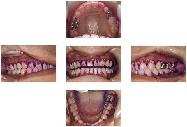 プラークの付着部分染め出し写真