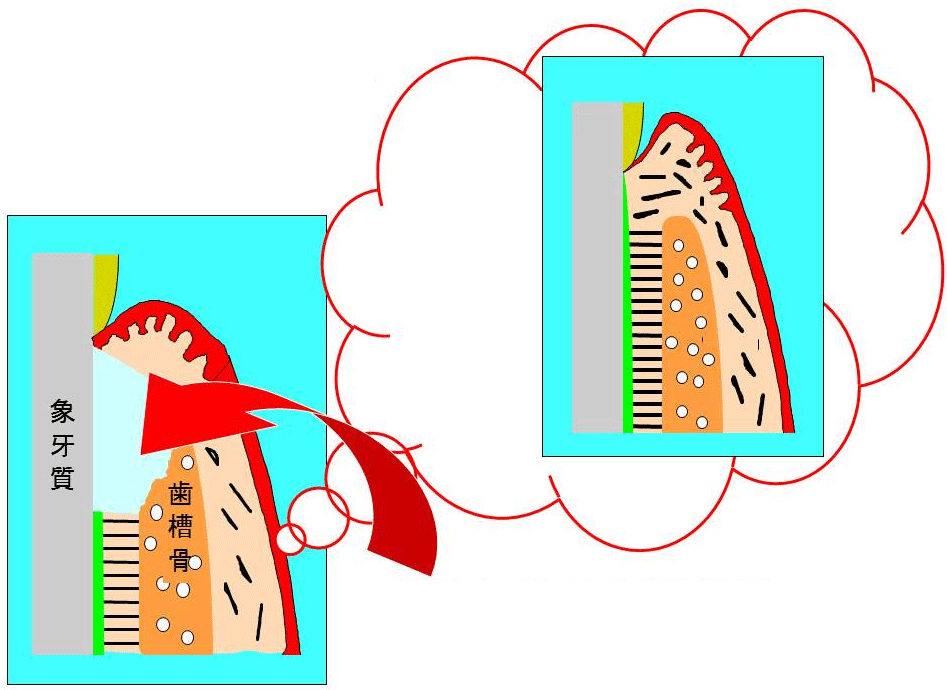 歯周組織を再生させるためには何らかの工夫が必要