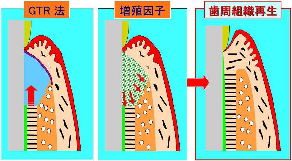 GTR法（左）　増殖因子（中央）→歯周組織再生（右）