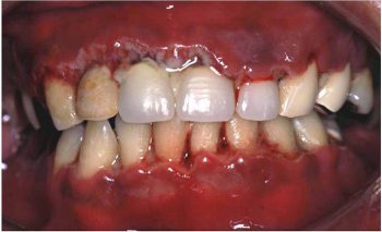 急性壊死性潰瘍性歯肉炎・歯周炎