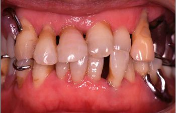 慢性歯周炎（一般的）