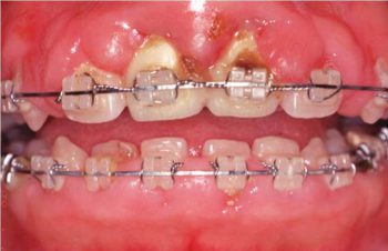 歯肉増殖症（矯正治療開始後約1年　口腔性清掃不良による）