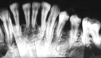 限局型侵襲性歯周炎　16歳　女性