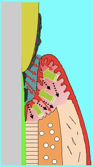 歯周病のメカニズムイメージ図
