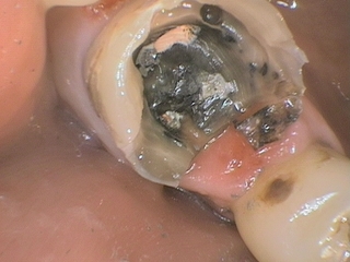 ペンスコープで撮影した虫歯