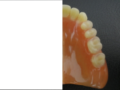 一般的な義歯