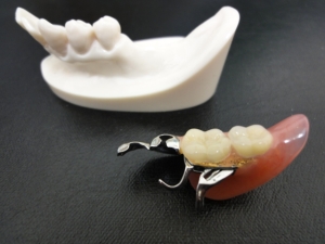入れ歯のサンプル 2