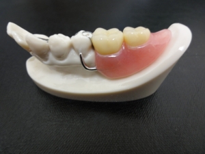 入れ歯のサンプル 4