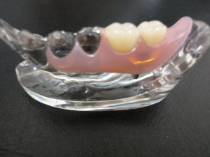 入れ歯のサンプル1