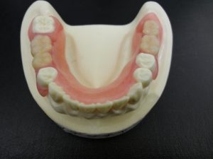 入れ歯のサンプル 3