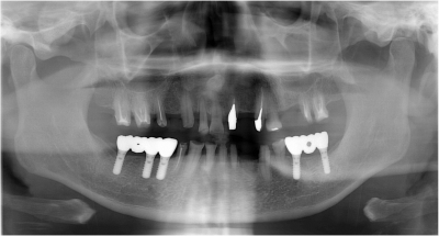 下の歯のインプラント治療終了後のレントゲン写真