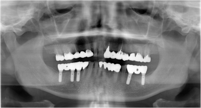 上の歯の治療に入った時のレントゲン写真