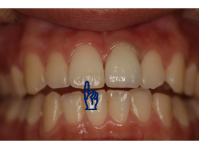 差し歯（被せ物）の場所