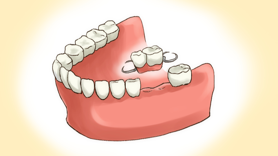 部分入れ歯のイメージイラスト