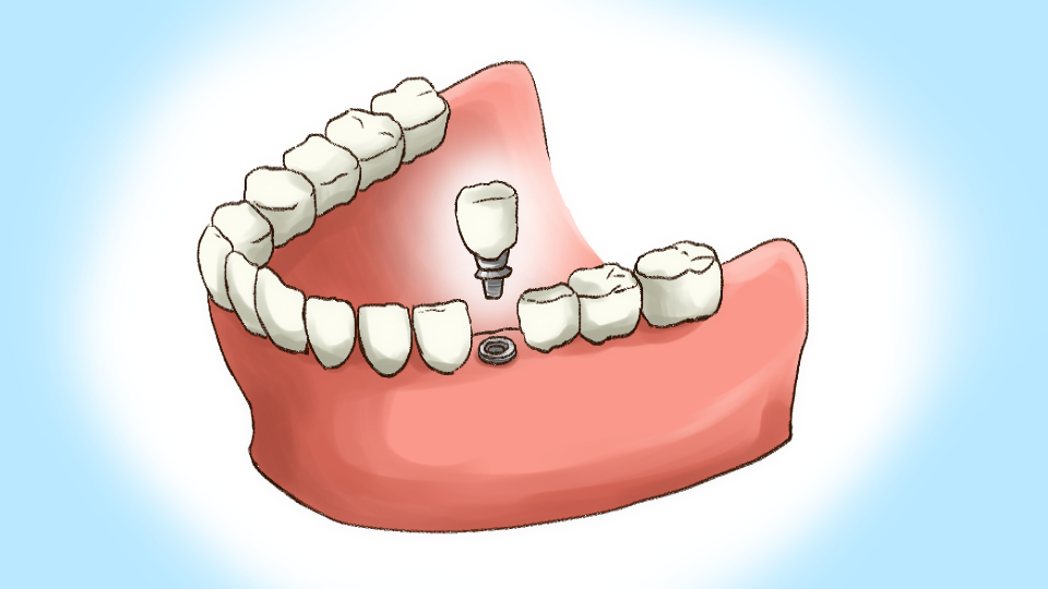 インプラントイメージイラスト