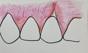 歯肉クレフト(歯肉の裂開)