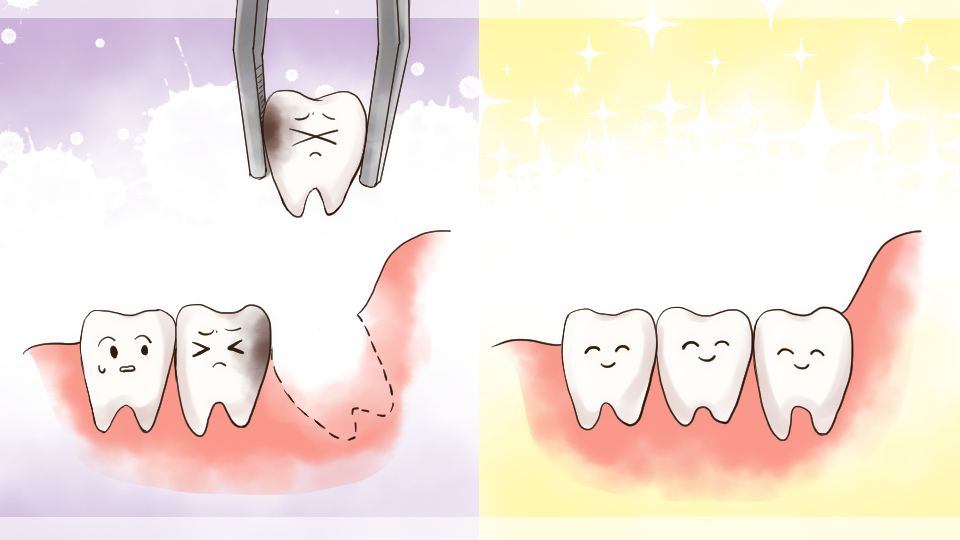 抜かれた歯と、抜かれていない歯のイメージ画