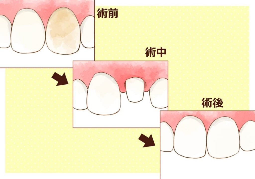 オールセラミッククラウンの術前と術中、術後のイメージイラスト