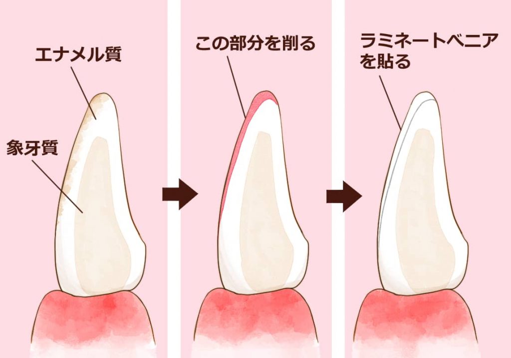 ラミネートベニアのフロー