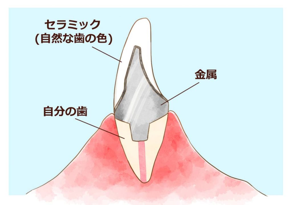 メタルボンド