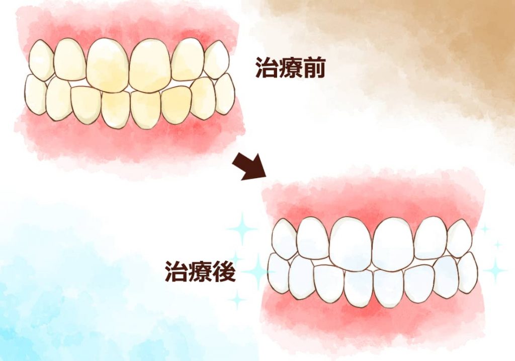 ホワイトニング治療前と後のイメージイラスト