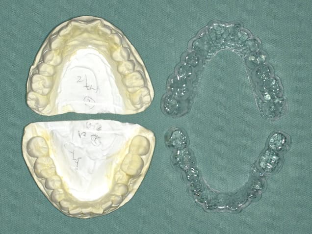 マウスピース術前