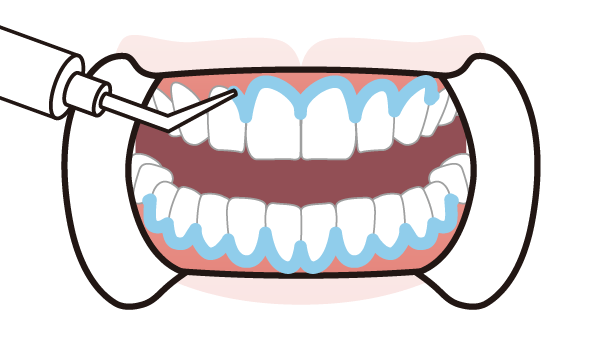 1.歯肉の保護